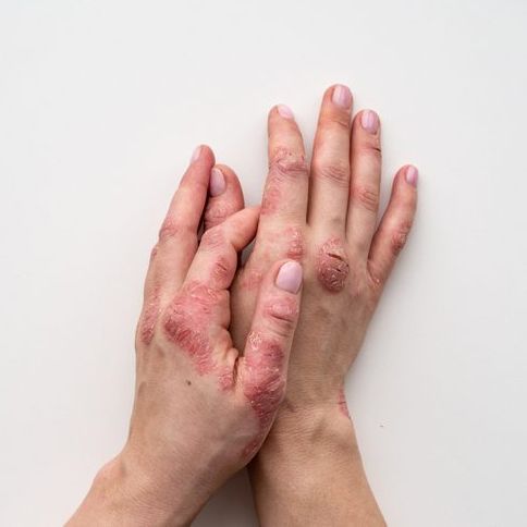Psoriasis-blog